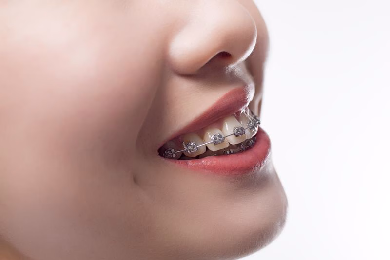 Braces in Los Angeles