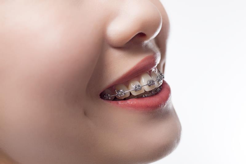 Braces
